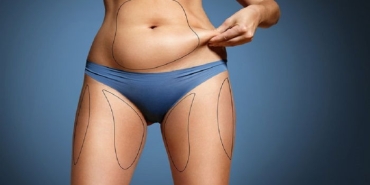 liposuction-NR1x3tgR.jpg