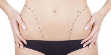 liposuction-bp9DMGzw.jpg