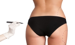 liposuction-lYdwHldp.jpg