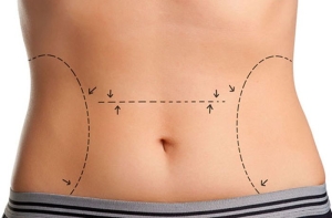 liposuction-qXsjxLVT.jpg