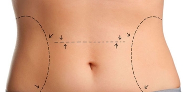 liposuction-qXsjxLVT.jpg