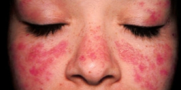 lupus-kelebek-hastaligi-nedir-belirtileri-nelerdir-lupus-hastaligi-tedavisi-var-mi-igS2Wfp1.jpg
