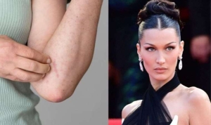 lyme-hastaligi-nedir-bella-hadidin-hastaligi-lymenin-belirtileri-nedir-lyme-hastaliginin-tedavisi-var-mi-MYBfjYtt.jpg