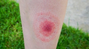 lyme-hastaligi-nedir-lyme-hastaligi-icin-hangi-doktora-gidilir-szcu2-7qfji2t2.jpg