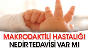 makrodaktili-hastaligi-nedir-JY7nbN4a.jpg
