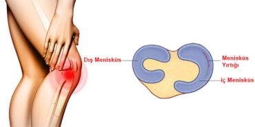 meniskus-nedir-meniskusler-ne-ise-fayda-NEvgbwHW.jpg