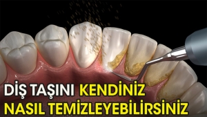 meskende-dis-tasi-pakligi-nasil-yapilir-3y3i8lzg.jpg