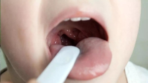 olumcul-bogaz-enfeksiyonu-strep-a-bakterisi-nedir-nasil-bulasir-strep-a-belirtileri-fyEFaP2V.jpg