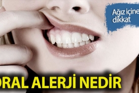 oral-alerji-nedir-7dp75B8m.jpg