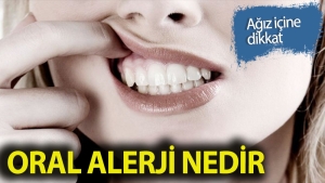 oral-alerji-nedir-7dp75B8m.jpg