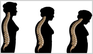 osteoporoz-kemik-erimesi-nedir-dBvpYxKx.jpg