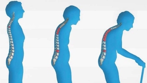 osteoporoz-nedir-KhD4cniD.jpg