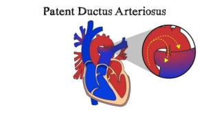 patent-duktus-arteriozus-nedir-A7WqBINb.jpg