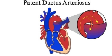 patent-duktus-arteriozus-nedir-A7WqBINb.jpg