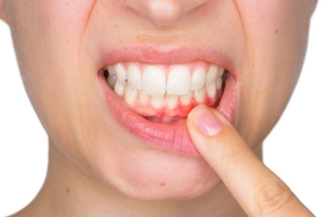 periodontitis-nedir-gingivitis-nedir-WPQxJS7y.jpg