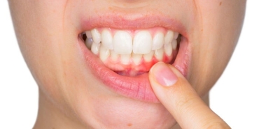 periodontitis-nedir-gingivitis-nedir-WPQxJS7y.jpg