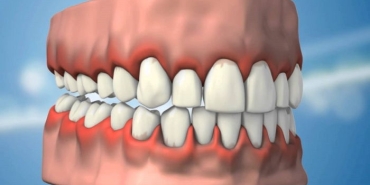 periodontoloji-nedir-dis-eti-hastalaklari-nelerdir-wXRishMZ.jpg