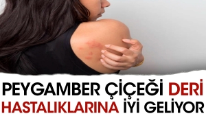 peygamber-cicegi-deri-hastaliklarina-uygun-geliyor-cUcju3mL.jpg
