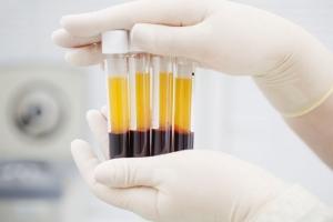prp-tedavisi-ile-bedeninize-nefes-aldirin-6NPaditZ.jpg