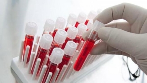 psa-prostat-spesifik-antijen-nedir-nasil-kiymetlendirilir-DISQTp64.jpg