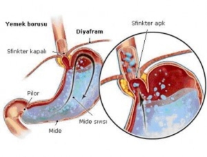reflu-nedir-ve-nasil-olusur-cgsmas46.jpg