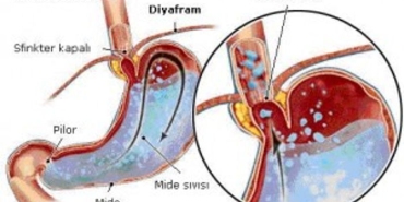 reflu-nedir-ve-nasil-olusur-cgsmas46.jpg