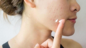roaccutane-nedir-sivilceler-icin-roaccutane-nasil-kullanilir-roaccutane-yan-tesirleri-nelerdir-6VzAftNU.jpg