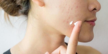 roaccutane-nedir-sivilceler-icin-roaccutane-nasil-kullanilir-roaccutane-yan-tesirleri-nelerdir-6VzAftNU.jpg