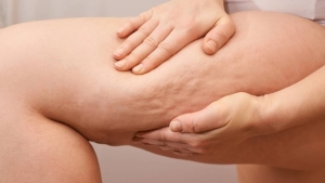 selulit-uzere-gorunen-lipodem-nedir-nasil-anlasilir-PSULAxgg.jpg