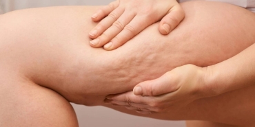 selulit-uzere-gorunen-lipodem-nedir-nasil-anlasilir-PSULAxgg.jpg