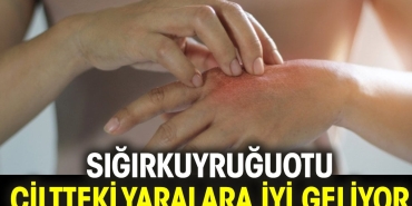 sigirkuyrugu-otu-ciltteki-yaralara-yeterli-geliyor-VSakiwqW.jpg