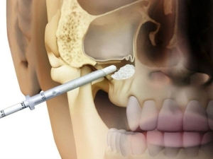 sinus-lifting-operasyonu-nedir-Y9LykXFu.jpg
