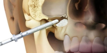 sinus-lifting-operasyonu-nedir-Y9LykXFu.jpg