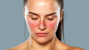 sistemik-lupus-eritematozus-nedir-FEqv9wJF.jpg