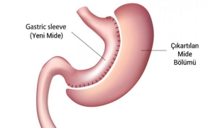 sleeve-gastrektomi-tup-mide-ameliyati-4RfugNgb.jpg