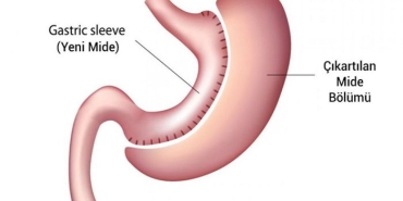 sleeve-gastrektomi-tup-mide-ameliyati-4RfugNgb.jpg