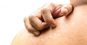 tinea-versicolor-nedir-ONPvg7Gw.jpg