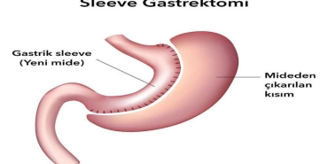 tup-mide-sleeve-gastrektomi-nedir-bwVkbSws.jpg