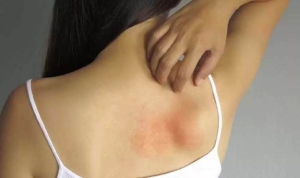 uyuzla-karistiriliyor-histamin-intoleransi-nedir-histamin-intoleransinin-sebepleri-nelerdir-eAWjUmss.jpg