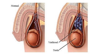 varikosel-nedir-AVHXARHY.jpg