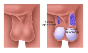 varikosel-nedir-c7h5lpg2.jpg