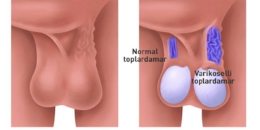 varikosel-nedir-c7h5lpg2.jpg