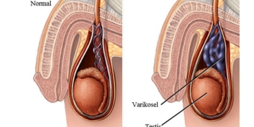 varikosel-nedir-tedavisi-nasil-yapilir-4IZVsbt1.jpg