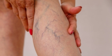 varis-nedir-neden-olusur-bacaklardaki-varislere-ne-uygun-gelir-Xvh8GjWY.jpg