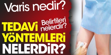 varis-nedir-varis-belirtileri-nelerdir-varis-tedavi-sistemleri-nelerdir-RhR624nk.jpg