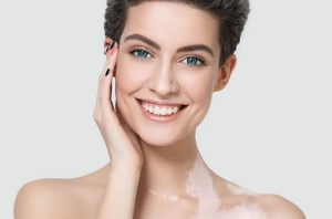 vitiligo-nedir-N4nc4hTV.jpg