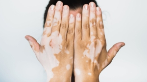 vitiligo-nedir-belirtileri-nelerdir-vitiligo-tedavi-edilir-mi-bulasici-midir-JNgY1ezq.jpg