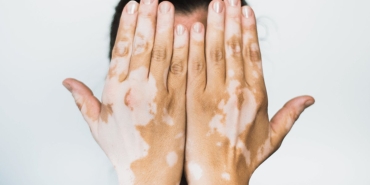 vitiligo-nedir-belirtileri-nelerdir-vitiligo-tedavi-edilir-mi-bulasici-midir-JNgY1ezq.jpg