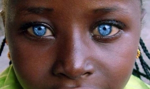 waardenburg-sendromu-nedir-hangi-genler-waardenburg-sendromuyla-baglidir-TWZuJM7s.jpg
